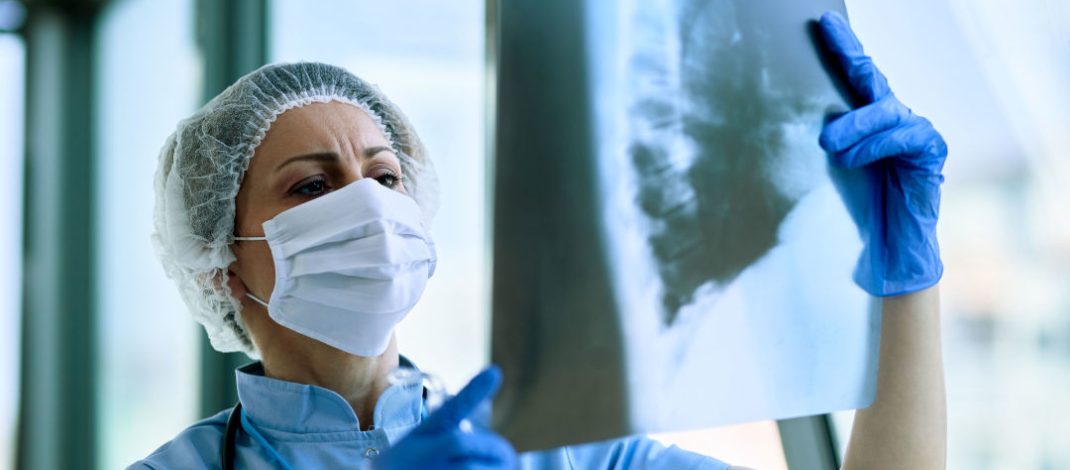 Intervención temprana es el mayor desafío en la atención de la fibrosis pulmonar idiopática