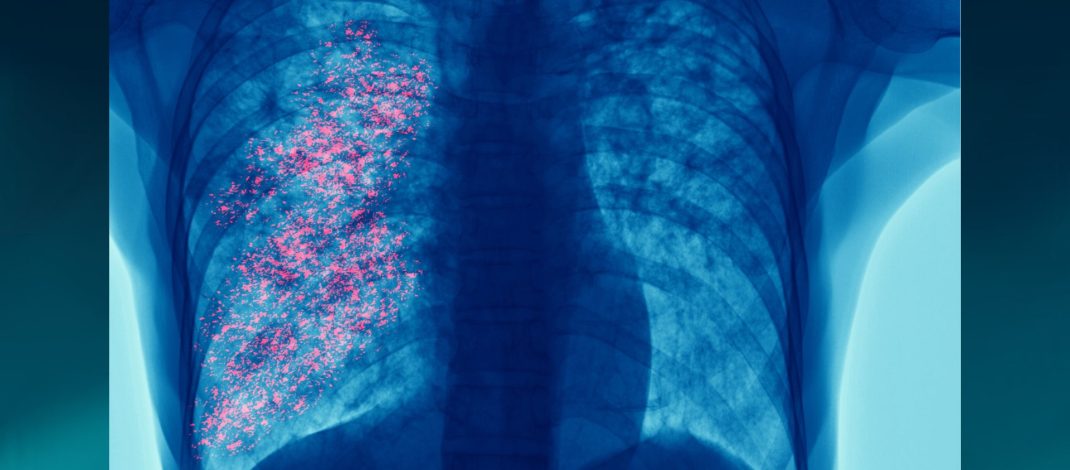 El cáncer de pulmón sigue siendo la principal causa de muerte por cáncer: la detección temprana es clave para cambiar esta realidad