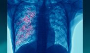 El cáncer de pulmón sigue siendo la principal causa de muerte por cáncer: la detección temprana es clave para cambiar esta realidad